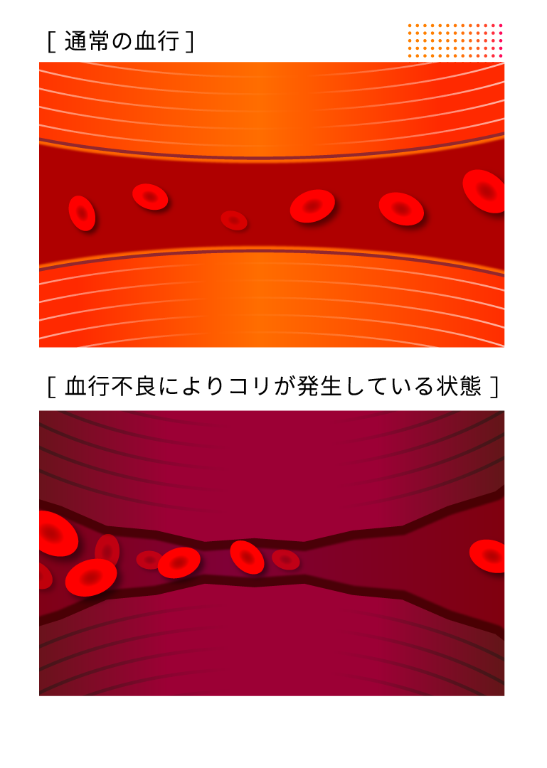 通常の血行　血行不良によりコリが発生している状態